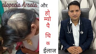 Alopecia areata with homoeopathy [upl. by Ahseinad]