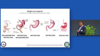 Bariatric surgery and other nonnutritional interventions for obesity and diabetes [upl. by Etiuqal603]