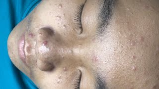 ACNE TREATMENT VU QUYNH MI  Blackheads Chin amp Nose Of Man 2024 EX [upl. by Yruam]