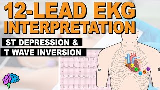 Myocardial Ischemia  ST Depression amp T Wave Inversion  12lead EKG [upl. by Grieve]