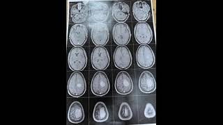 Resection of a parasagittal Meningioma [upl. by Gerita234]