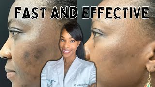 Do Chemical Peels Really Make A Difference [upl. by Plusch]