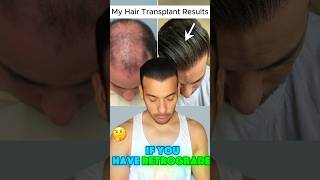 Can You Get A Hair Transplant with Retrograde Alopecia [upl. by Brianna811]