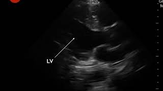 Video 6 Hyperdynamic LV contractility [upl. by Alodee]