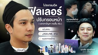 🚩ดาราหนุ่ม คุณ quotอ้น อัครวัฒน์quot เข้าคลินิกฉีดฟิลเลอร์ ลั่น❗️ชอบผลลัพธ์มาก ประทับใจฝีมือคุณหมอต้นสุดๆ [upl. by Alf276]