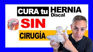 ✅cómo Curar una HERNIA Discal SIN cirugía ❌ [upl. by Schreiber]