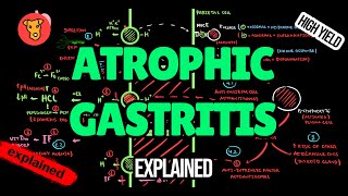 ATROPHIC GASTRITIS Pathogenesis Diagnostic criteria Treatment [upl. by Nimar123]