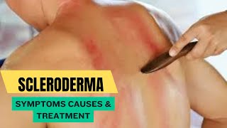 Scleroderma Symptoms Causes amp Treatment [upl. by Onafets]