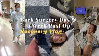 L5S1 Laminectomy  Microdiscectomy Surgery Day amp 1 Week Post Op  Recovery by Betty [upl. by Derron]