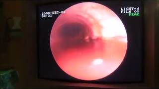 Endoscopia traqueal equina hemorragiaEquine tracheal endoscopy hemorrhage [upl. by Sitnik252]