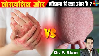 Eczema और Psoriasis में क्या अंतर है   Allergy  Itching in Body  Ayurveda  सोरायसिस  एक्जिमा [upl. by Eremahs843]