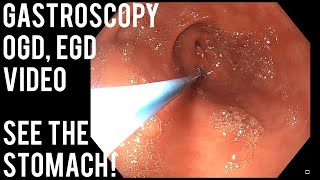 Gastroscopy  OGD  See inside the stomach [upl. by Rehm]