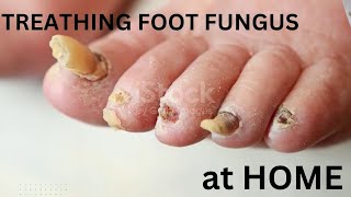 HOW TO TREATH FOOT FUNGUS AT HOME [upl. by Renaxela]