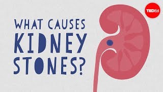 What causes kidney stones  Arash Shadman [upl. by Stelu13]