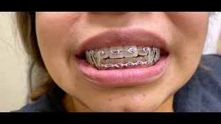 Braces IPR Interproximal Reduction  Rubber Bands  Tooth Time Family Dentistry New Braunfels [upl. by Blader]