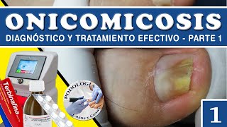 PARTE 1  ONICOMICOSIS  Diagnóstico y Tratamiento Efectivo  Podología Casos y Cosas [upl. by Tenneb582]