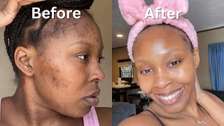 How I Cleared My Acne  Dark Spots  Hyperpigmentation for good in 1 month NO ACCUTANE VIDEO PROOF [upl. by Einrae209]