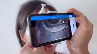 Check meibomian gland with smartphone meibographer MeiboVue [upl. by Fregger]