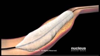 Non Cardiac Percutaneous Transluminal Angioplasty [upl. by Luna457]