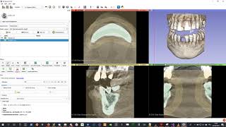 Tutorial How To Create STL segmentation from DICOM using 3D Slicer Virteasy Dental  Editor [upl. by Canty57]