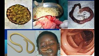 Ascaris Lumbricoides Ascariasis Morphology  Life cycle  Pathogesis  Treatment  Parasitology [upl. by Dolley379]