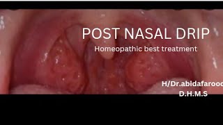 POST NASAL DRIP homeopathic best medicinemedicircle7553 [upl. by Gothard998]