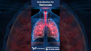 Varicocele I Varicocele Embolization I Embolization for Varicocele [upl. by Collum]