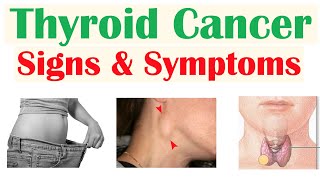 Thyroid Cancer Signs amp Symptoms amp Why They Occur [upl. by Bonine]