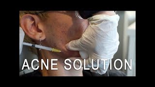 Cystic Acne Solution Kenalog Injection [upl. by Aihsercal]