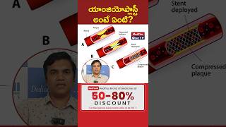 Understanding Angioplasty and Stenting Quick Guide l Dr A Ravikanth shorts MedPlusONETV [upl. by Assilym]