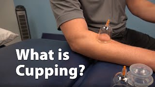 What is Cupping [upl. by Aerbas282]