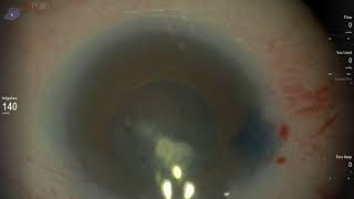 Phaco In Micro Cornea [upl. by Cordle375]