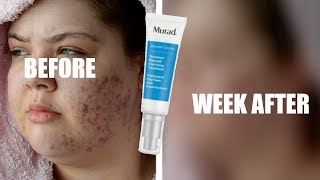 TESTING MURAD OUTSMART BLEMISHACNE TREATMENT FOR A WEEK OILYACNE PRONE SKIN [upl. by Airelav]