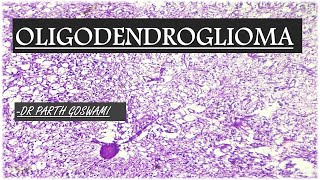 Oligodendroglioma [upl. by Elaina]