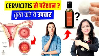 Ayurvedic Treatment For Cervicitis  CERVICITIS TREATMENT  बच्चेदानी के मुख की सूजन  कारण और इलाज [upl. by Llenrac365]