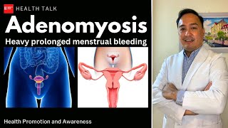 Do you have heavy prolonged menstrual period Baka Adenomyosis na yan [upl. by Handler]