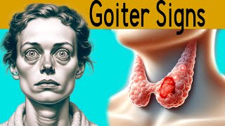 Goiter explained under 3 minutes Causes Symptoms Treatment [upl. by Arraet474]