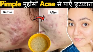 सिर्फ 7 दिनों में PIMPLESमुंहासे दागधब्बे Acne Marks को जड़ से खत्म करेंपाए बेदाग़ Glowing Skin💕 [upl. by Keryt474]