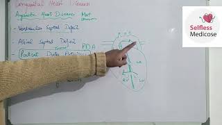 FCPS part 1CVS lecture 20 ACYANOTIC HEART DISEASES made easy [upl. by Nalek]