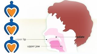 Orofacial cleft schisis  What is an orofacial cleft [upl. by Netniuq441]