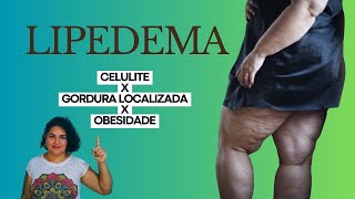 Como diferenciar Lipedema de gordura localizada celulite e obesidade sintomas [upl. by Aicylla]