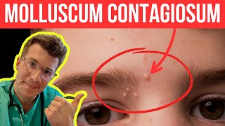 Doctor explains Molloscum Contagiosum viral skin infection  Causes symptoms and treatment [upl. by Aribold]