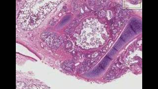 Histopathology Lung lymph node  Asthma [upl. by Kilby]