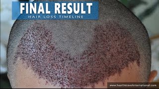 FUE Hair Transplant  Final Hair Loss Results Timeline  2100 Grafts  Treatment  Baldness for men [upl. by Trahern859]