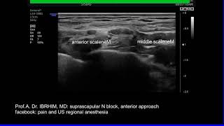 suprascapular nerve block anterior approach [upl. by Christabel]