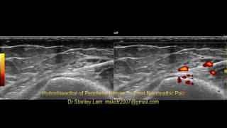 Ultrasound Guided Hydrodissection of Obturator Nerve and Saphenous Nerve at the Adductor Tubercle [upl. by Sayles]