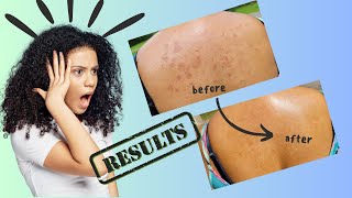 Amazing Natural Remedies for Eczema Relief  Bye Itchy Skin [upl. by Damali]