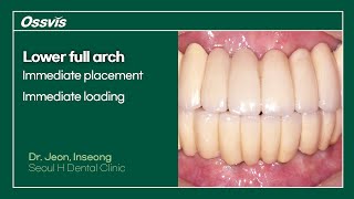 Clinical Case Lower full arch immediate placement amp loading [upl. by Wyatan338]