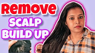 HOW TO GET RID OF SCALP BUILDUP FAST amp EASY [upl. by Bil]