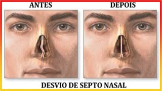 Septoplastia desvio de septo  Turbinectomia cornetos nasais 1º SEMANA RELATO [upl. by Elletnohs]